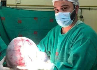 Idosa retira cisto gigante de 10 kg; veja as fotos