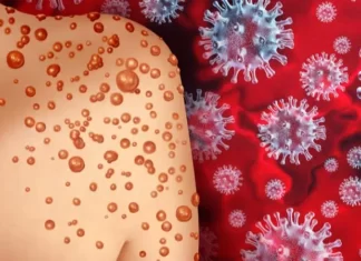 Varíola dos macacos já foi identificada em mais de 30 países