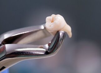 Mulher morre após extração de dente