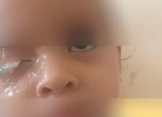 Menina de 2 anos gruda olho com supercola e espera 5 dias por cirurgia