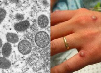 Número de casos de varíola dos macacos chega a 106 no Brasil