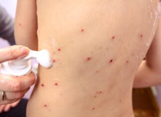 Varíola dos macacos: veja lista de sintomas e como se proteger