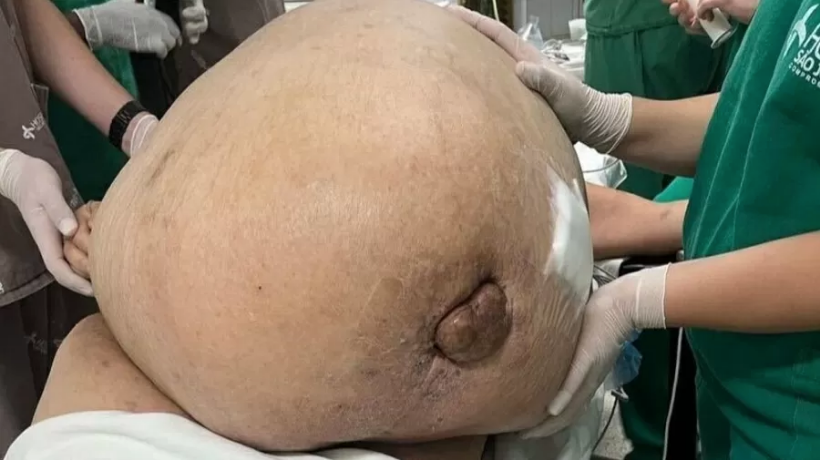 A paciente é natural de Minas Gerais mas morava em Itaperuna. Segundo o cirurgião, ela convivia com o tumor há cinco anos – Foto: Reprodução
