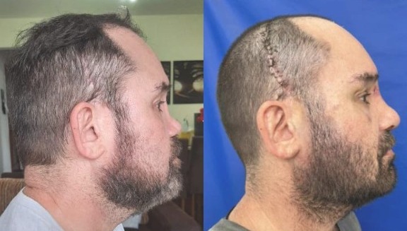 Picasso antes da cirurgia (à esquerda), com o nariz sem a base óssea, e ao lado, após a cirurgia, com o nariz reconstruído e marcas de curativos na cabeça - Foto: Divulgação