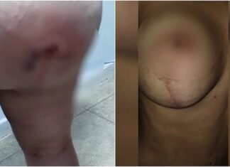 Técnica em enfermagem denuncia que teve parte do bumbum necrosado após cirurgias