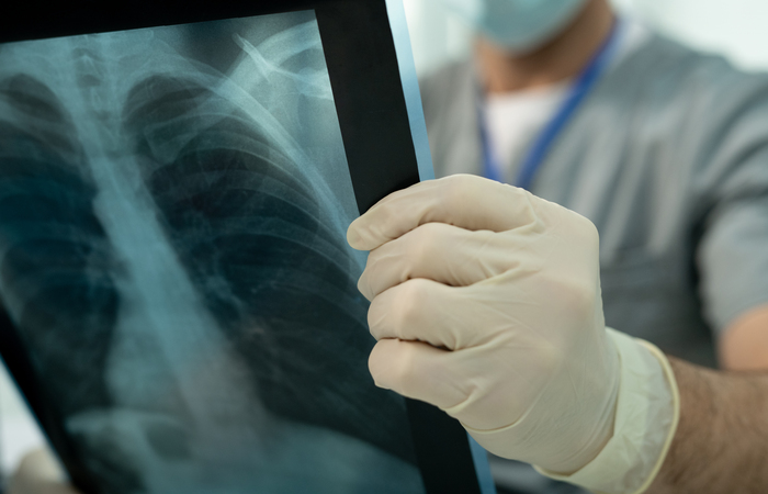 Paciente descobriu câncer no pulmão graças a exames para cirurgia de retirada de tumor na mama e precisou passar por tratamentos concomitantes - Foto: Divulgação