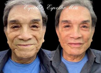 Caso Dedé Santana: especialista comenta cuidados e benefícios ao optar pela harmonização facial na terceira idade