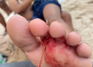 Criança tem pé perfurado por ferrão de arraia na praia