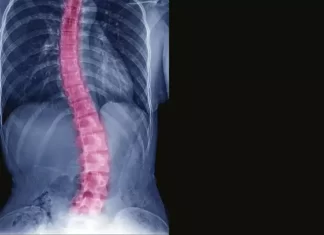 Volta às aulas: Médico alerta para a importância do diagnóstico precoce da escoliose