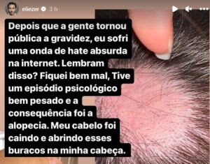 Saiba como tratar a alopecia areata utilizando apenas 3 ingredientes