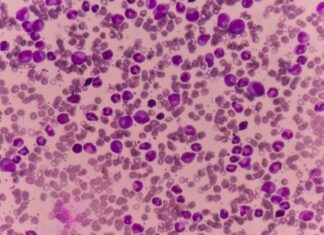 Tratamento experimental cura 18 pacientes com leucemia, mostra estudo