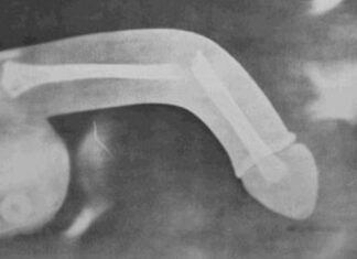 Fratura peniana: posição sexual mais comum, entre os brasileiros, pode ser a mais problemática