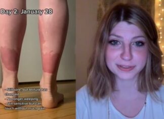 Vídeo : Mulher sofre com condição rara que faz sua pele descamar rapidamente