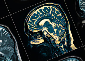 Hábito pouco higiênico pode favorecer o Alzheimer, alerta estudo