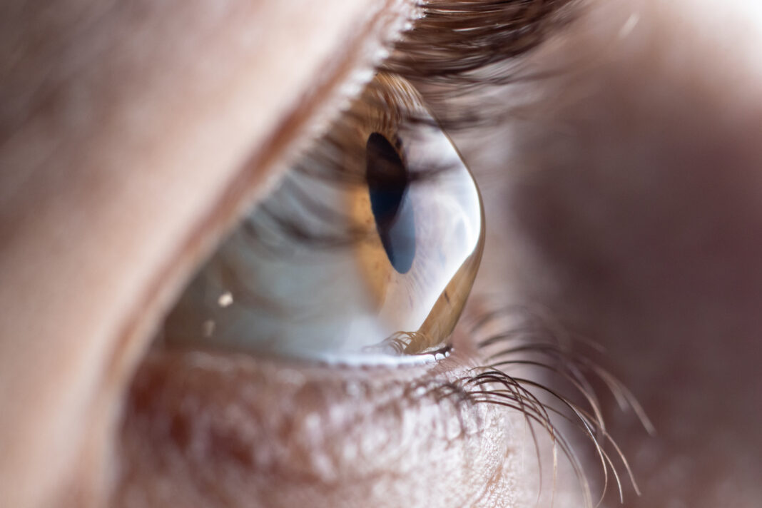Macro eye photo. Keratoconus - eye disease, thinning of the cornea in the form of a cone. The cornea plastic