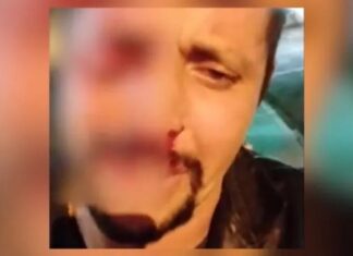 Homem é confundido com ladrão, perde o olho e fica desesperado: ‘Por causa de um otário’; veja