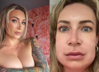 Vídeo : Atriz pornô fica com rosto deformado após fazer preenchimento labial