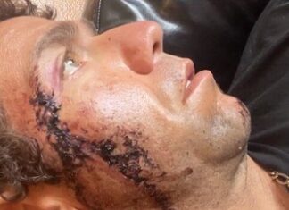 Surfista toma 18 pontos no rosto após ser mordido por tubarão em praia dos Estados Unidos