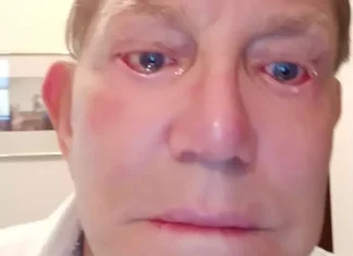 Homem fica quatro anos sem conseguir fechar os olhos após cirurgia estética retirar muita pele de seu rosto
