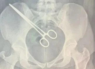 Mulher descobre pinça dentro do corpo em visita na cadeia