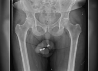 Idoso com impotência enfia 3 baterias no pênis e perde parte do órgão