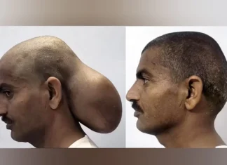 Homem tira tumor do tamanho de um melão da cabeça após 15 anos com ele