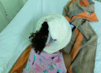 Criança de 3 anos fica gravemente ferida após ser atacada por pitbull no interior do Piauí