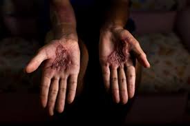 Absurdo: Vítima de pais de santo teve língua e mãos queimadas com colher quente