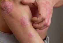 Dia Mundial da Psoríase: Doença afeta muito além do físico, emocional de pacientes também sofre
