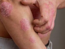 Dia Mundial da Psoríase: Doença afeta muito além do físico, emocional de pacientes também sofre