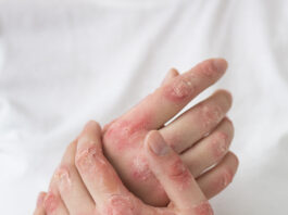 Psoríase ainda é cercada de estigmas e exige diagnóstico precoce, alertam dermatologistas do CEJAM