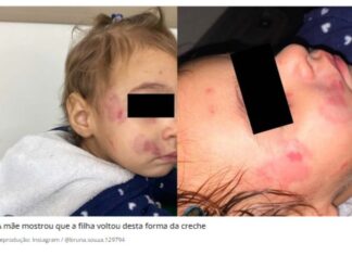 Mãe expõe que filha voltou assim da creche no interior de SP