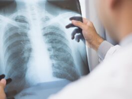 Anvisa aprova novo medicamento para câncer de pulmão avançado